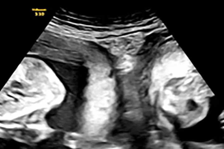 ‘One in a million’: Woman pregnant in 2 uteruses gives birth to twins