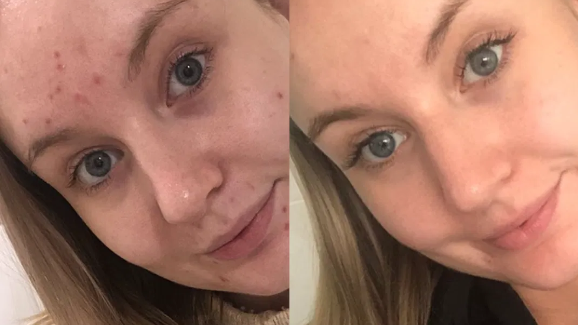 Shoppers rush to buy The Breakout Hack’s spot treatments starting from £13