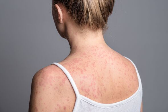 World Cup fans returning from US warned over carrying ‘humankind’s most contagious virus’