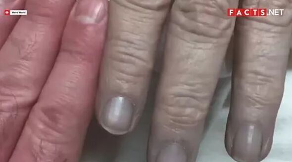 Decades of incest caused isolated family to be born with blue skin